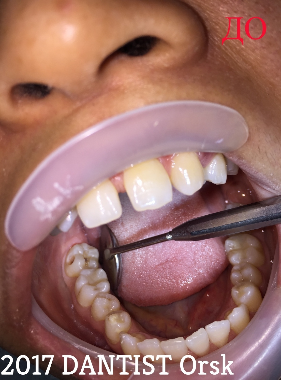 Отсутствие зубов приводит к старости и нарушениям в организме