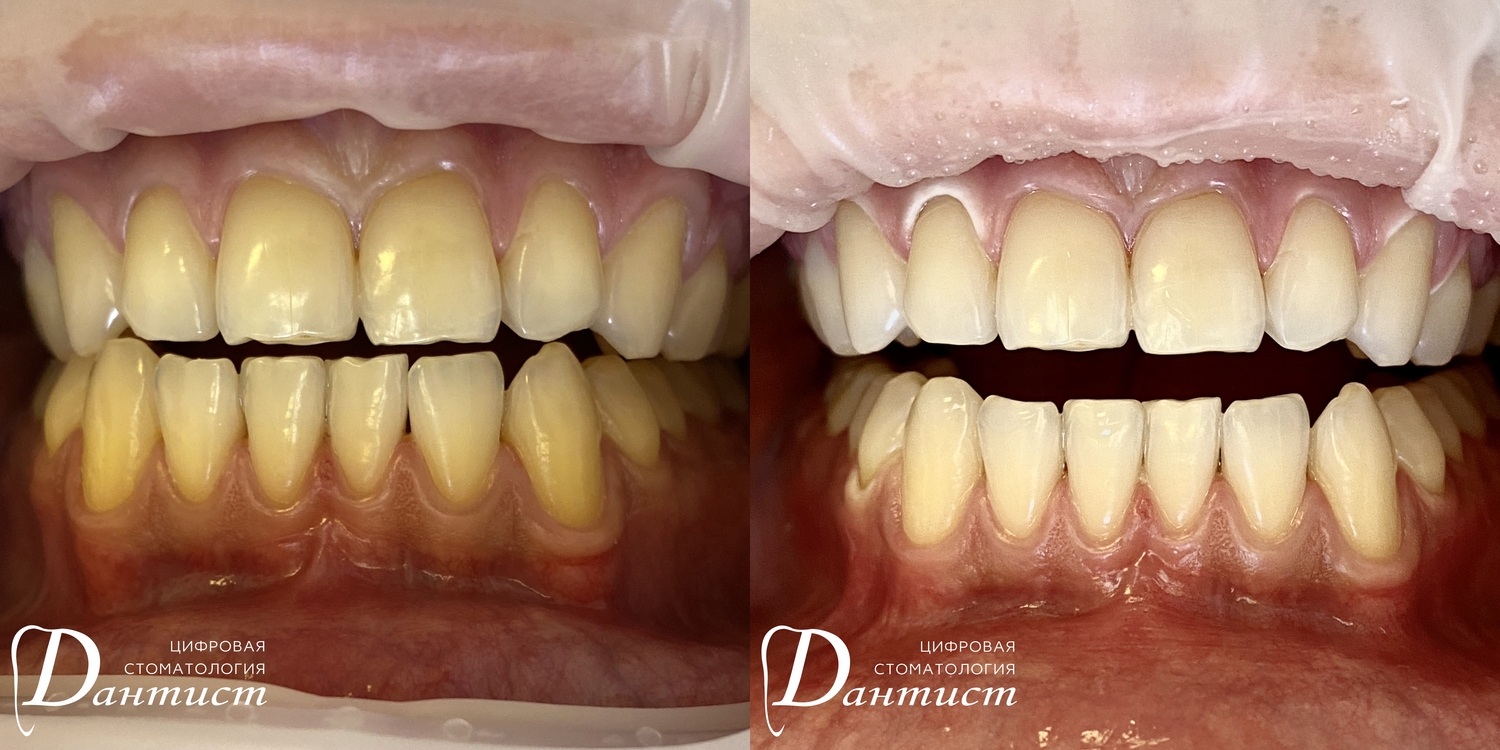 Кабинетное отбеливание зубов. Лазерное ламповое световое химическое ...